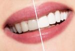 teeth-whitening