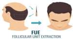 Follicular Unit Extraction