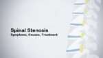 Spinal Stenosis