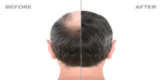 hair transplantation in Pune (2)