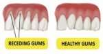 receding-gums-vs-healthy-gums-schematic